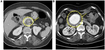 Case Report: Superior mesenteric artery vasculitis causing aneurysm following COVID-19 infection